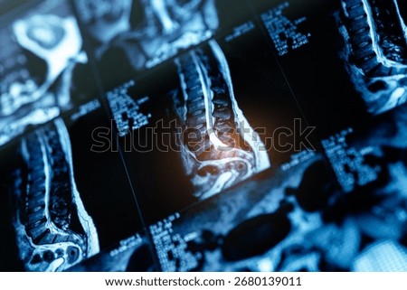 Pinched sciatic nerve in leg buttock, Detailed mri scan of spine highlighting lumbar protrusion with sunlight.