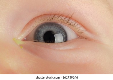 Pink eye (Conjunctivitis) infection on a baby