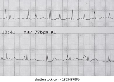 Pitfalls In Cardiology: Projecting Two Different Rhythms On Top Of Each Other In A Holter EKG 