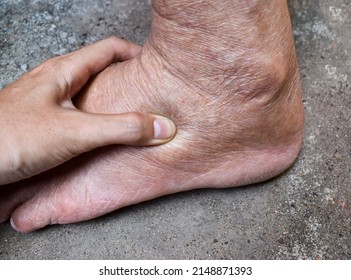 Pitting Edema Of Lower Limb. Swollen Leg Of Asian Old Man.