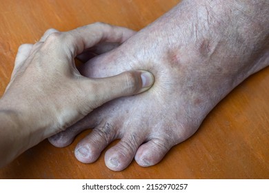 Pitting edema of lower limb. Swollen foot of Asian old man.