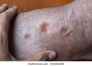 Pitting Edema Of Lower Limb. Swollen Leg Of Asian Old Man.