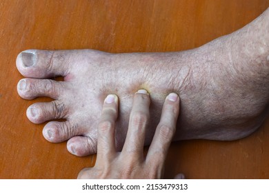 Pitting Edema Of Lower Limb. Swollen Foot Of Asian Old Man.