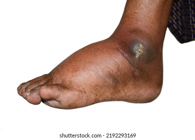 Pitting Edema Of Lower Limb. Swollen Leg Of Asian Old Man.