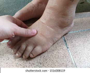 Pitting edema or swelling feet of the old lady, Water retention or edema occurs when excess fluids build up inside your body and can be a symptom of a severe medical condition, kidney disease