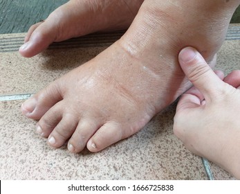 Pitting edema or swelling feet of the old lady, Water retention or edema occurs when excess fluids build up inside your body and can be a symptom of a severe medical condition, kidney disease