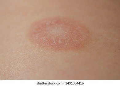 Pityriasis Images Stock Photos Vectors Shutterstock