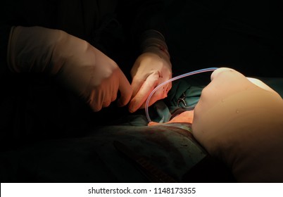 Placement of Radivac Drain into Mastectomy wound before closure of skin.