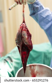 Placenta With Amniotic Sac.