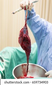 Placenta With Amniotic Sac.