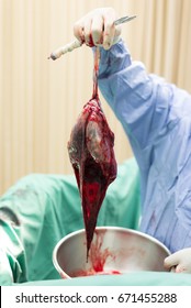 Placenta With Amniotic Sac.