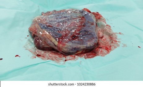 Placenta Of The New Born Baby With Cord Blood.