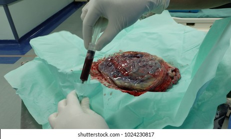 Placenta Of The New Born Baby With Doctor Taking Sample Of The Cord Blood.