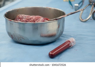 Placenta Of The New Born Baby In Stainless Basin With Medical Scissors And Cord Blood Sample In Tube For Laboratory On Blue Background In Operating Theater,Freshly Removed Placenta After C-section,