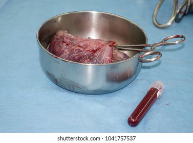 Placenta Of The New Born Baby In Stainless Basin With Medical Scissors And Cord Blood Sample In Tube For Laboratory On Blue Background In Operating Theater,Freshly Removed Placenta After C-section,