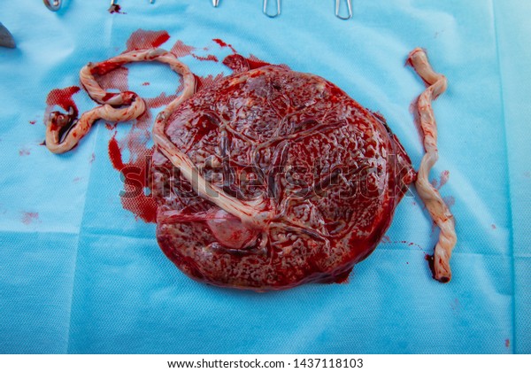 Placenta and\
Umbilical Cord of newly born\
baby
