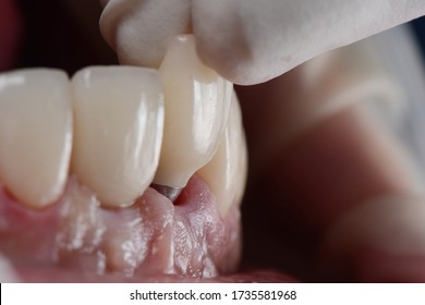 Placing Ceramic Dental Crown On Dental Implant In The Front Tooth.