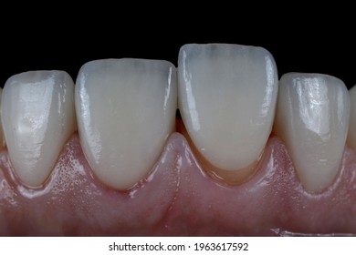 Placing Moment Of Ultra Thin 0.5 Mm Thick Of Porcelain Laminated Veneer On The Front Teeth.