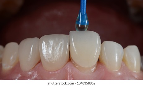 Placing porcelain laminated veneer onto the teeth result in perfect well-aligned teeth.