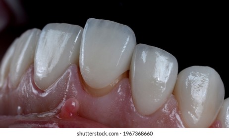 Placing very thin porcelain laminated veneers on discoloured teeth to make over to Hollywood smile. 