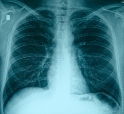 Plain chest x-ray, normal lungs, a Health & Medical Photo by Theo's Stuff