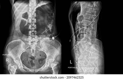 Plain Film Of Human's Abdomen Show Distended Stomach