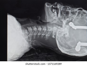 A Plain Lateral Radiograph Or X-ray Showing Bilateral Facet Joint Dislocation Of C6/7 Spinal Level. The Patient Has Spinal Cord Injury And Initially Treated With Skull Traction.