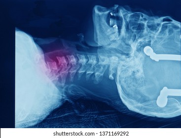 A Plain Lateral Radiograph Or X-ray Showing Bilateral Facet Joint Dislocation Of C6/7 Spinal Level. The Patient Has Spinal Cord Injury And Initially Treated With Skull Traction.