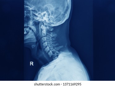 A Plain Lateral Radiograph Or X-ray Showing Bilateral Facet Joint Dislocation Of C6/7 Spinal Level. The Patient Has Spinal Cord Injury And Need Emergent Surgery.