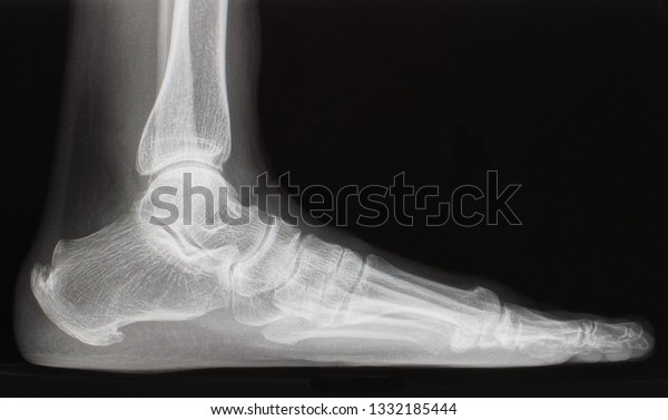Plain Lateral Xray Radiograph Foot Ankle Stock Photo (Edit Now) 1332185444
