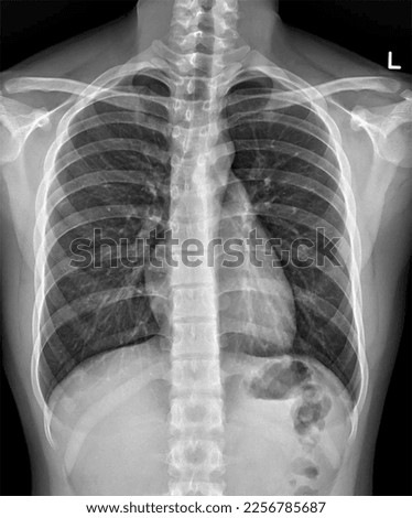 Plain radiograph on dark background in hospital. The film use for diagnosis the illness of patient.Medical concept.Normal chest x ray.Xray for diagnosis of pneumonia, tuberculosis TB and silicosis.
