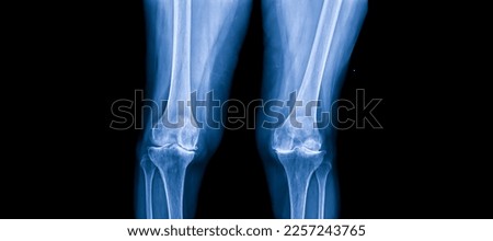 Plain radiograph on dark background in hospital.The xray use for diagnosis of the illness of patient.Medical concept.Osteoarthritis of knee in elderly woman.The blue tone of xray shows joint narrowing