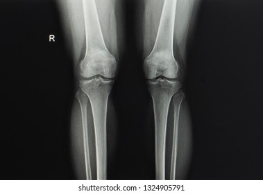 A Plain Radiographs Of Both Knees Showing Osteoarthritis At The Medial Side That Cause Knee Pain. The Knee Alignment Show Valgus Angulation Or Knock Knee.