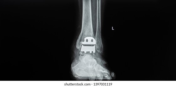 Plain Radiography Of Ankle Joint After Total Ankle Replacement Surgery In Anteroposterior Projection. The Film Shown The Prosthesis In Good Position. Dark Background. Radiology And Medical Concept.