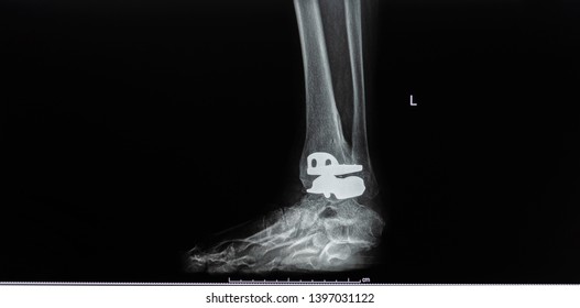 Plain Radiography Of Ankle Joint After Total Ankle Replacement Surgery In Oblique Projection. The Film Shown The Prosthesis In Good Position. Dark Background. Radiology And Medical Concept.