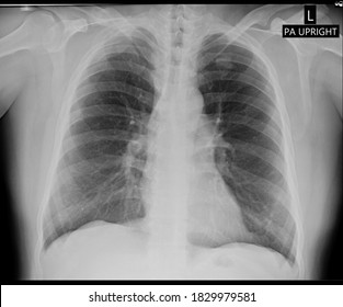 Plain Radiography Of Human Thorax Show Traumatic Right 3rd - 4th Rib Fracture