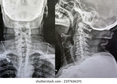x ray cervical spine tumor