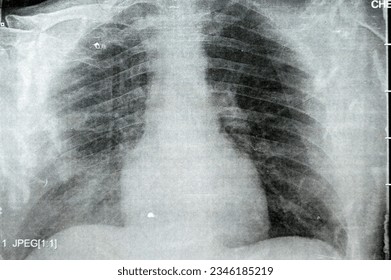 Plain x ray chest showing infectious pulmonary process pneumonia with right side minimal para-pneumonic effusion, right sided aspiration pneumonia that could be complicated to empyema