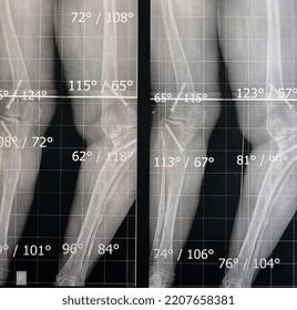 Plain X Ray Long Film Standing Position Showing Both Legs With Bilateral Metaphyseal Genu Varum, Previous Epiphysiodesis, Left Distal Femur Valgus And Left Medial Tibial Plateau Depression