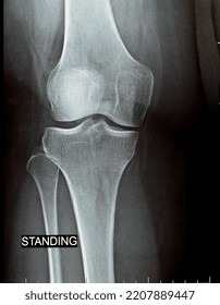 Plain X Ray On Knee Joint Stock Photo 2207889447 | Shutterstock