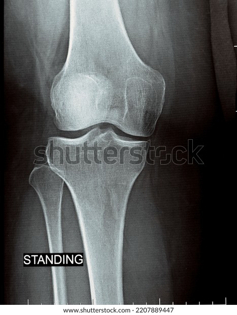 Plain X Ray On Knee Joint Stock Photo 2207889447 | Shutterstock