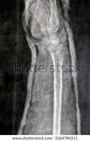 Plain X ray of right forearm (mistakenly written Left on the film) showing fracture of the lower part of ulna in cast for 4 weeks and started to heal with bone displacement, needed internal fixation