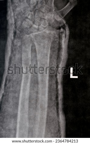 Plain X ray of right forearm (mistakenly written Left on the film) showing fracture of the lower part of ulna in cast for 4 weeks and started to heal with bone displacement, needed internal fixation