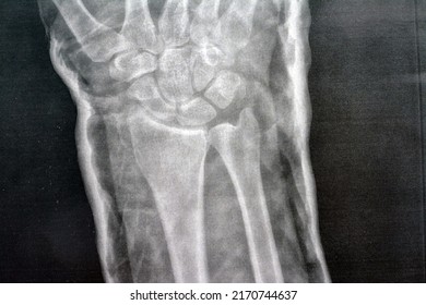 La articulación de la muñeca derecha de rayos X muestra la fractura del radio distal derecho, reducción cerrada y fundición realizada, enfoque selectivo de la imagen de rayos X que muestra la fractura de hueso del radio después de un trauma directo en la muñeca