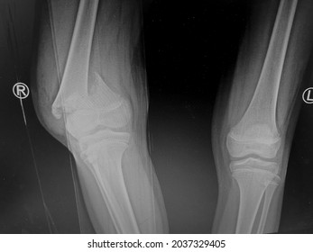 La radiografía simple de ambas articulaciones de rodilla muestra fractura cerrada en el fémur distal derecho.