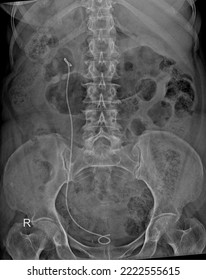 Plain X-Ray Kidney,Ureter,Bladder Showing Double J(DJ) Stent  - Shutterstock ID 2222555615