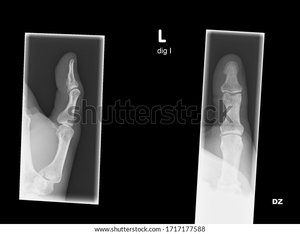 Plain x-ray of a thumb in two\
plains showing a bennett\'s fracture of the first metacarpal\
bone