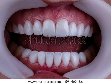 Similar – gap between one’s teeth