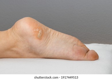 Plantar wart close up on the bottom of a female foot heel caused by the human papillomavirus, or HPV.