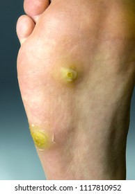 Plantar Wart - Two Warts On The Skin Of The Sole Of The Foot